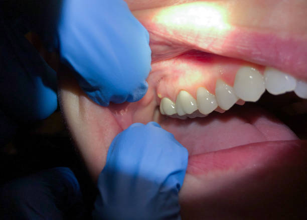 Best Emergency Broken Tooth Repair in Cayuga Heights, NY
